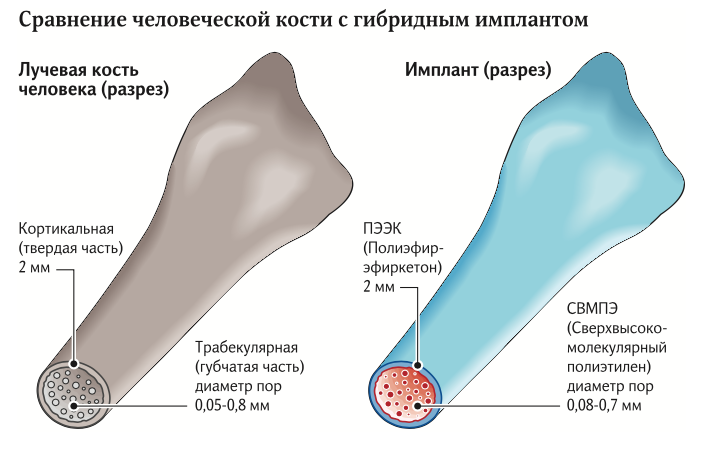 имплант